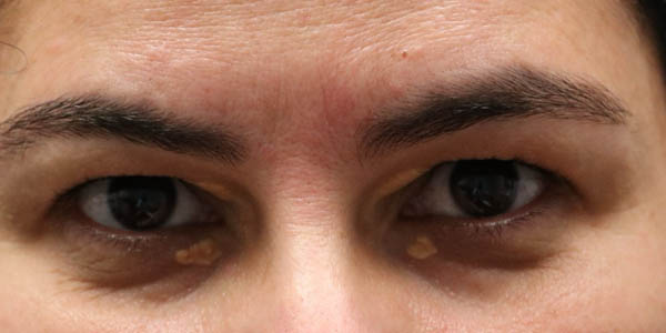 _0000_patient 1 before xanthelasma excision.PNG