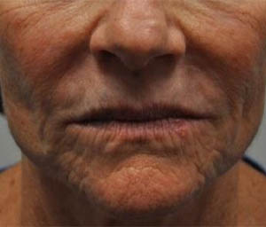 _0000_patient 2 before lip filler.PNG
