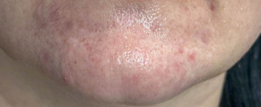 _0000_patient 5 before PRP with microneelding.PNG