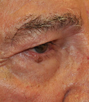 _0000_patient 5 before lesion removal.PNG