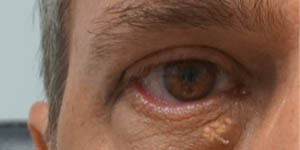 _0000_patient 6 before xanthelasma removal.jpg