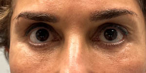_0001_PATIENT 3 AFTER SUBBROW FILLER.PNG