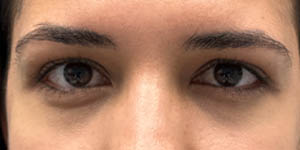 _0001_Patient 1 after Lower Bleph with micro Fat Grafting.jpg