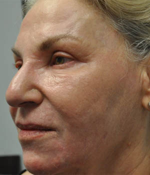 _0001_patient 1 after CO2.PNG