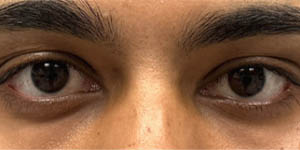 _0001_patient 1 after left upper lid ptosis repair with subbrow filler.PNG