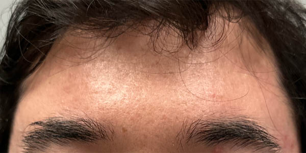 _0001_patient 1 after m8 (front).PNG