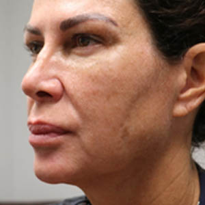 _0001_patient 1 after submental accutite.PNG