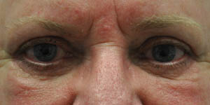 _0001_patient 1 after upper and lower bleph.PNG