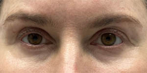 _0001_patient 1 after upper bleph with subbrow filler.PNG