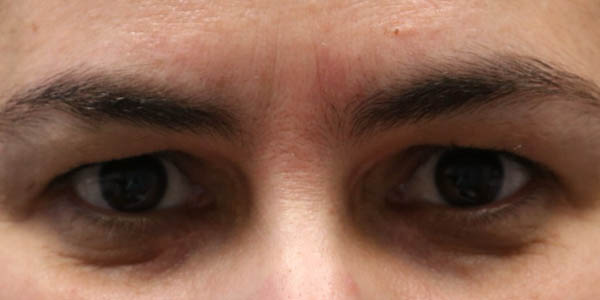 _0001_patient 1 after xanthelasma excision.PNG