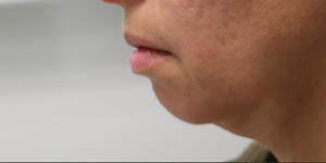 _0001_patient 1 before chin and jawline filler.PNG