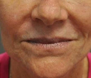 _0001_patient 2 after lip filler.PNG