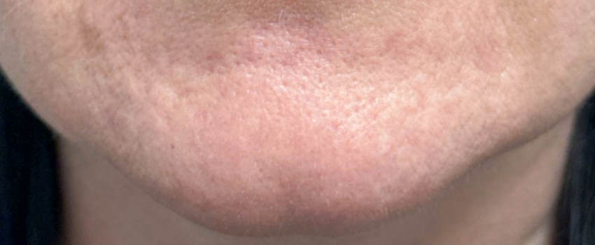 _0001_patient 5 after PRP with microneelding.PNG