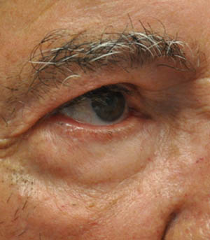 _0001_patient 5 after lesion removal.PNG
