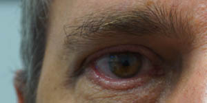 _0001_patient 6 after xanthelasma removal.jpg