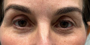 _0002_PATIENT 4 BEFORE SUBBROW FILLER.PNG