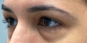 _0002_Patient 1 before side Lower Bleph with micro Fat Grafting.jpg