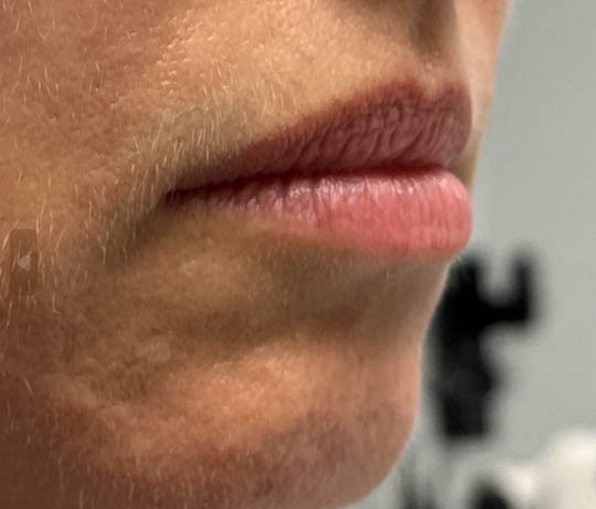 _0002_patient 1 before lip filler (right side).PNG
