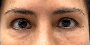 _0002_patient 1 before subbrow filler.jpg