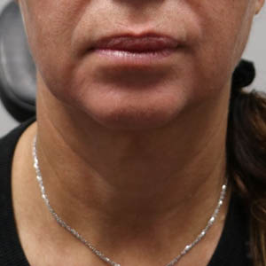 _0002_patient 1 before submental accutite (front).PNG