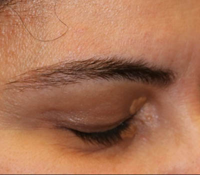 _0002_patient 1 before xanthelasma excision (side).PNG