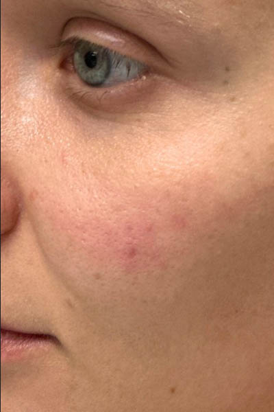 _0002_patient 2 before PRP with microneedling.PNG