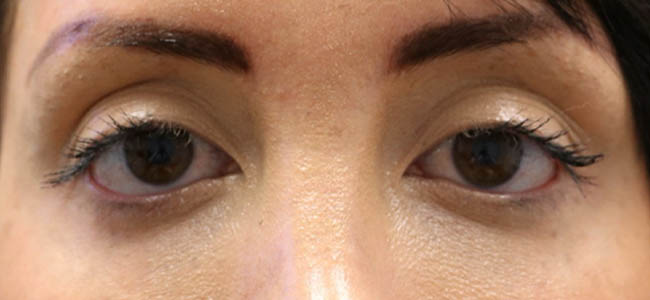 _0002_patient 2 before ptosis repair and subbrow filler.PNG