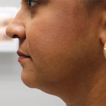 _0002_patient 2 before submental accutite.PNG