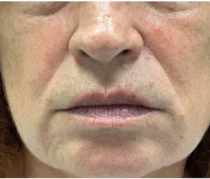 _0002_patient 3 before lip filler.PNG