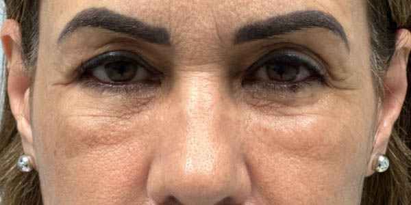 _0002_patient 4 before morpheus (for festoons).PNG
