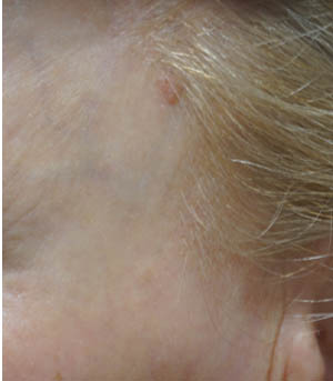_0002_patient 6 before lesion remova.PNG