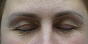 _0002_patient 7 before xanthelasma excision.PNG