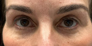_0003_PATIENT 4 AFTER SUBBROW FILLER.PNG