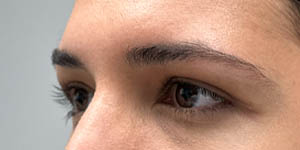 _0003_Patient 1 after side Lower Bleph with micro Fat Grafting.jpg