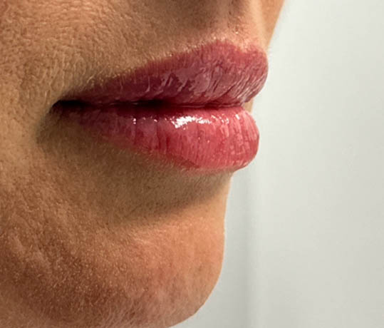_0003_patient 1 after lip filler (right side).PNG