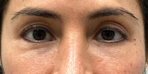 _0003_patient 1 after subbrow filler.jpg