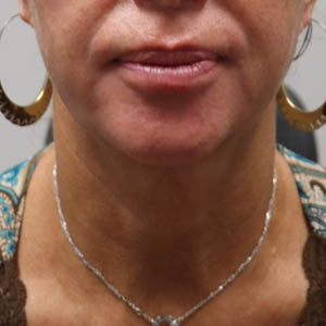_0003_patient 1 after submental accutite (front).PNG