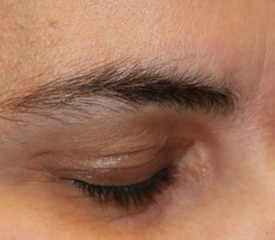 _0003_patient 1 after xanthelasma excision (side).PNG