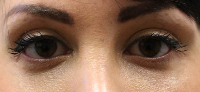 _0003_patient 2 after ptosis repair and subbrow filler.PNG