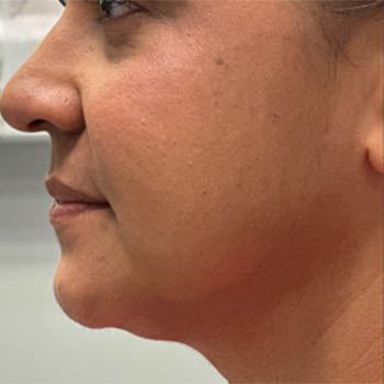 _0003_patient 2 after submental accutite.PNG