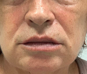 _0003_patient 3 after lip filler.PNG