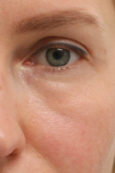 _0003_patient 3 after morpheus (for pores).PNG