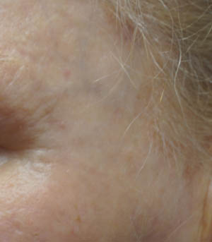 _0003_patient 6 after lesion remova.PNG