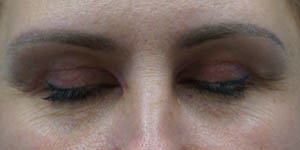 _0003_patient 7 after xanthelasma excision.PNG