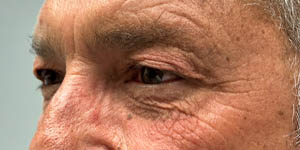 _0004_PATIENT 5 BEFORE SUBBROW FILLER.PNG