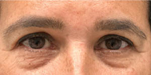 _0004_patient 2 before lower bleph with facial fat grafting (front).PNG