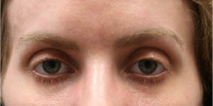 _0004_patient 2 before subbrow filler.PNG