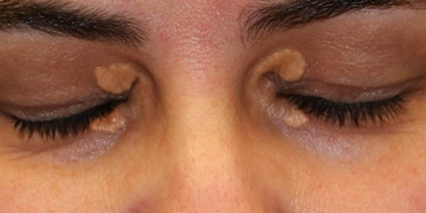 _0004_patient 2 before xanthelasma excision.PNG