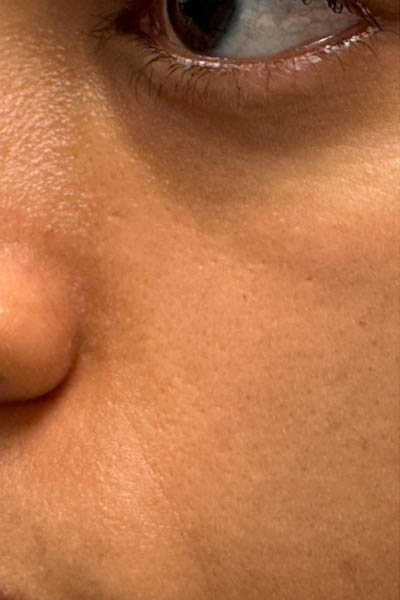 _0004_patient 3 before PRP with microneelding and PRF to undereyes (left side).PNG