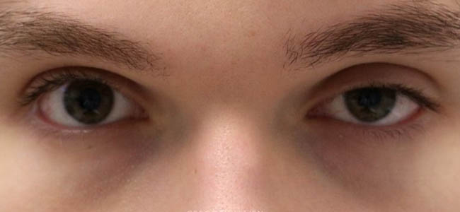_0004_patient 3 before ptosis repair and subbrow filler.PNG